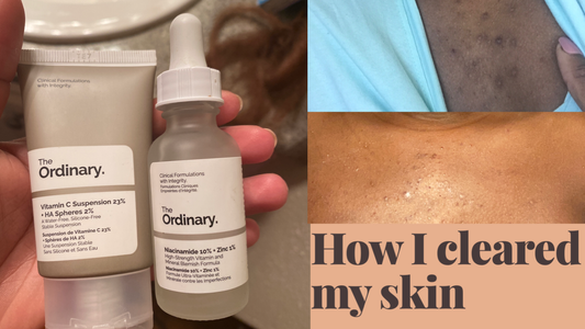 Clearing my skin with The Ordinary